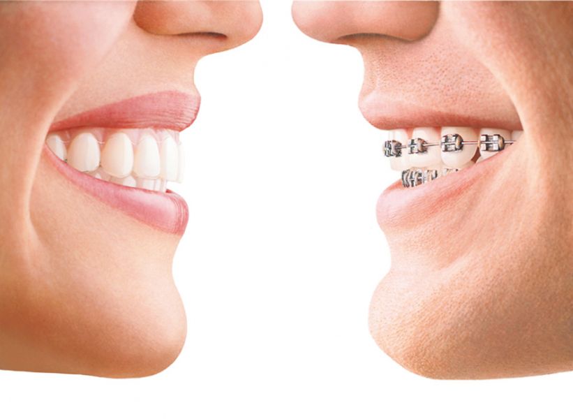 Invisalign Braces - Invisalign Orthodontics Treatment Blackburn | Healthy Smiles 