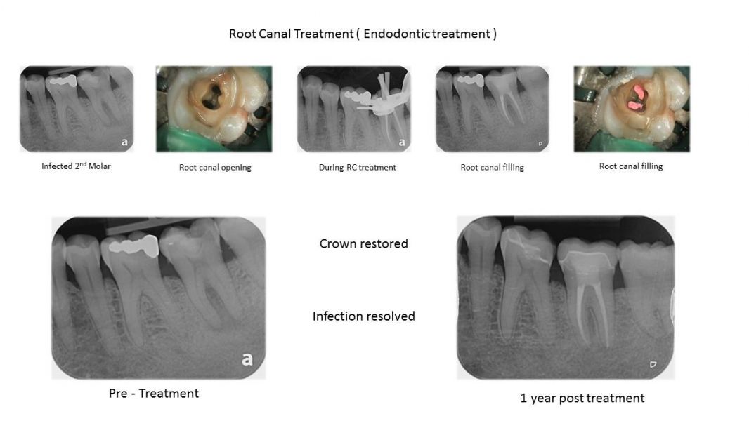 Root Canal Dental Treatment Claremont