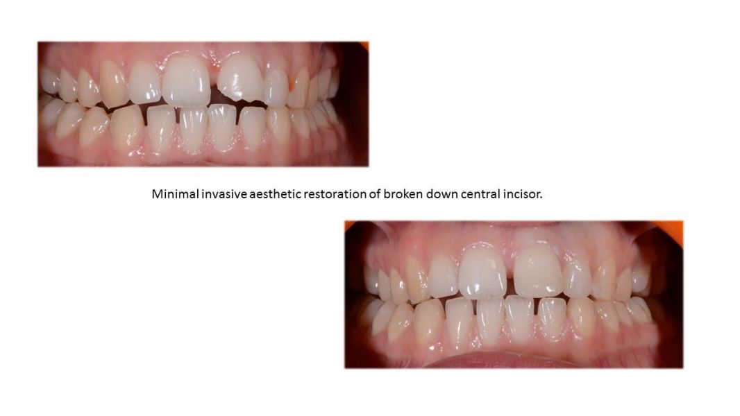 Dental Bonding – White Fillings & Dental Teeth Bonding