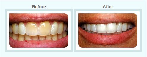 Smile Designing and Smile Makeover Treatment by Healthy Smiles