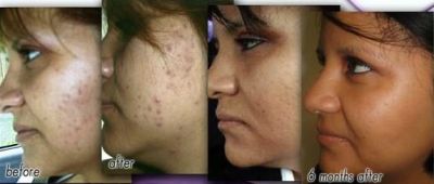 Healthy, Smoother, Younger Skin Without Medical Intervention