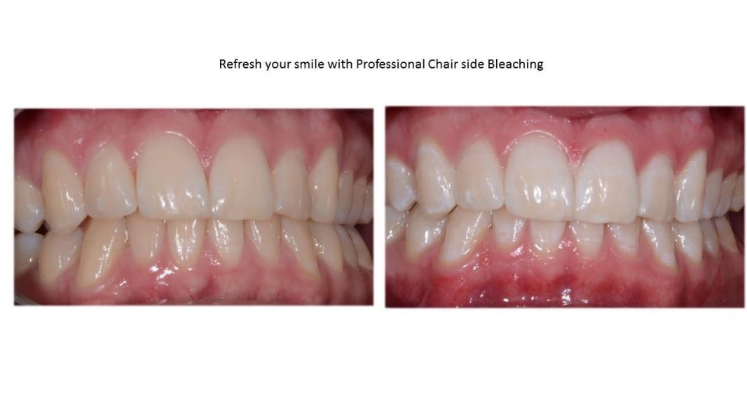 Mouth Guard Sports – Dental Mouth Guards at Ashton Dental clinic, Claremont