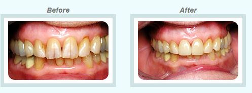 Porcelain Crowns and Veneers Treatment by Healthy Smiles 