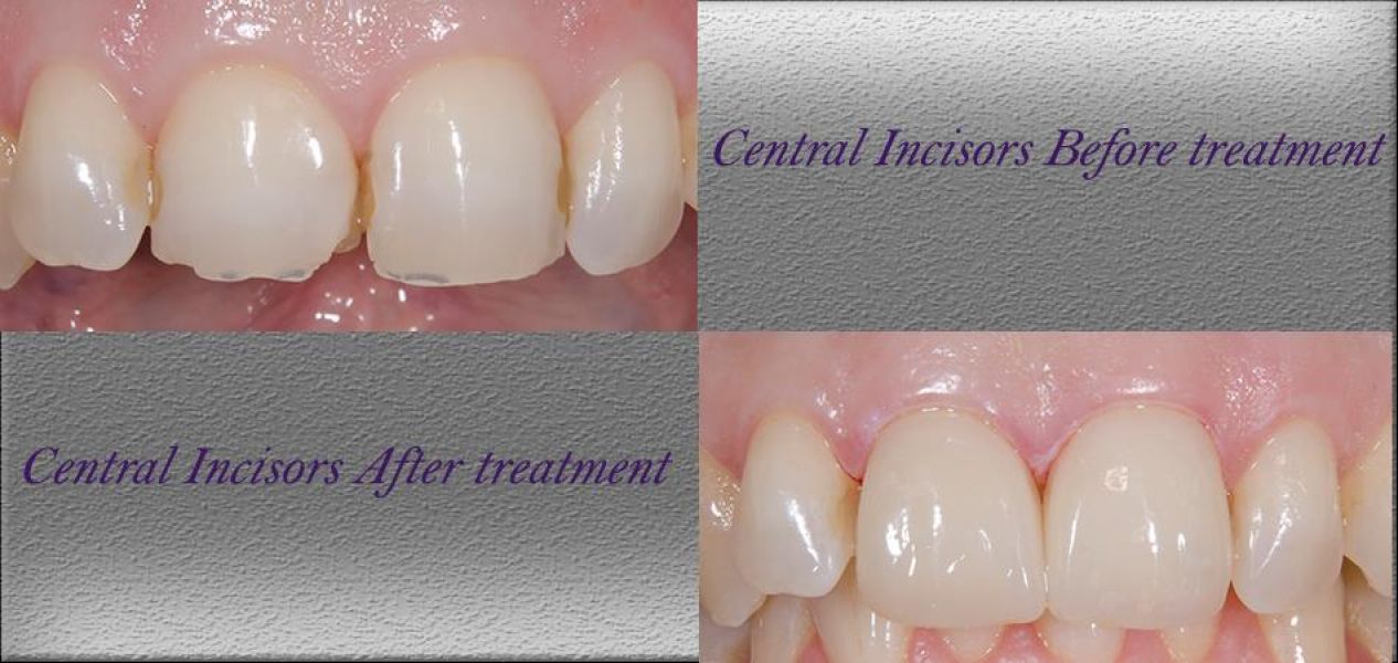 Teeth Whitening Dentist in Claremont