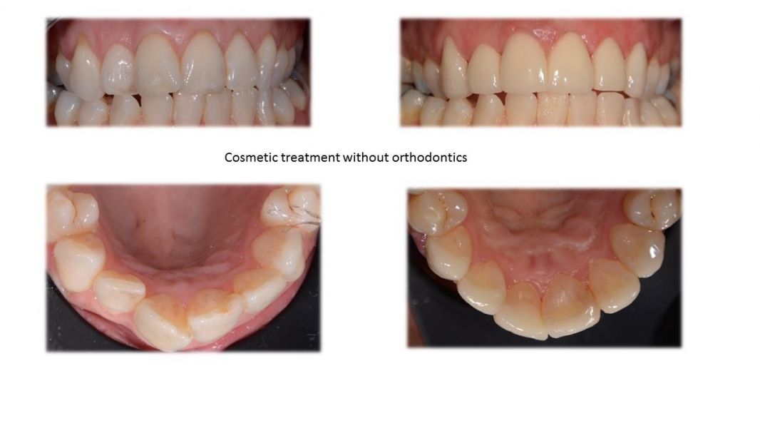 Single Visit CEREC Porcelain Restoration - Ashton Avenue Dental Clinics