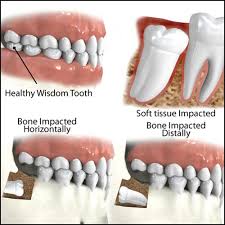 Wisdom Teeth Removal And Extraction – Healthy Smiles
