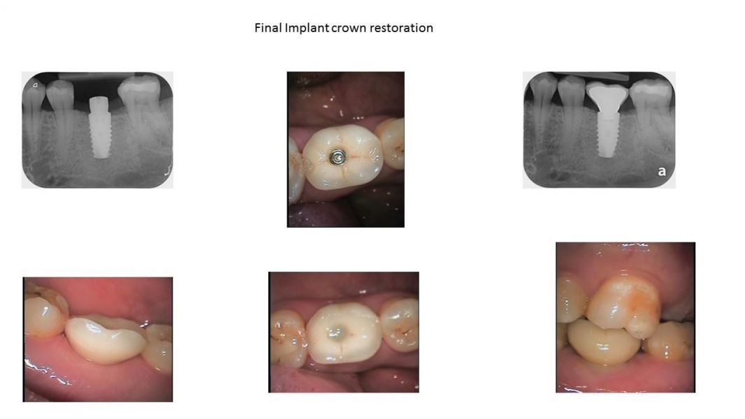 Dental Implant Treatment - Affordable Way to Replace a Missing Tooth